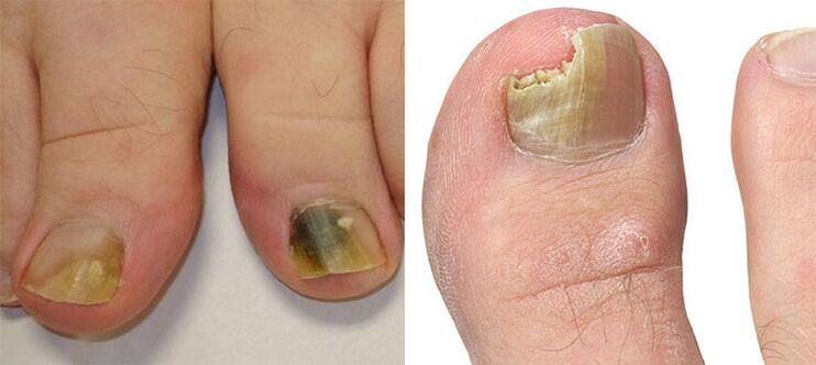 Onychomycosis - Zniszczenie paznokci grzybem