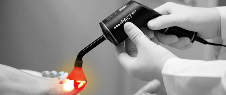 laserowe leczenie grzybicy paznokci